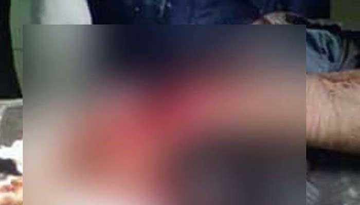 বাউফলে সন্ত্রাসি হামলায় ছাত্রলীগ কর্মীর হাত বিচ্ছিন্ন