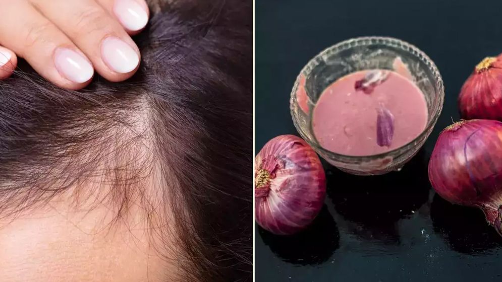 চুল গজাতে পেঁয়াজের রস, লাভ হচ্ছে না ক্ষতি?