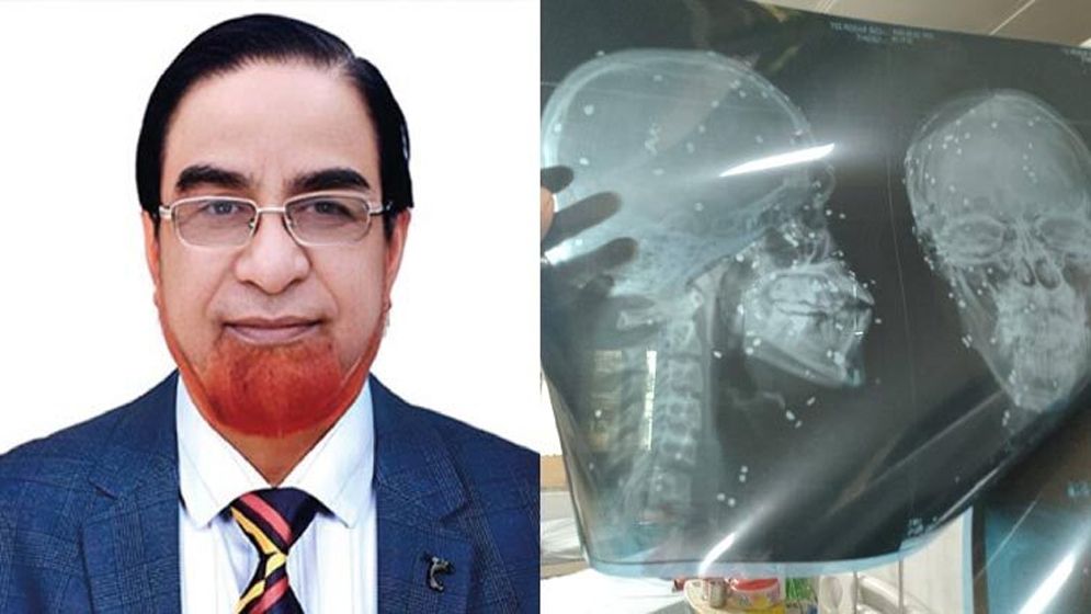 বাহারের নির্দেশে গুলিতে ঝাঁজরা, চোখ হারিয়ে আদালতে মামলা