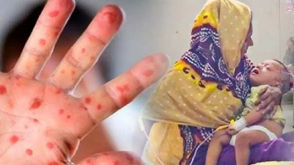 হামের ২৪ ঘণ্টায় আক্রান্ত প্রায় ৯০০, মৃত্যু ২