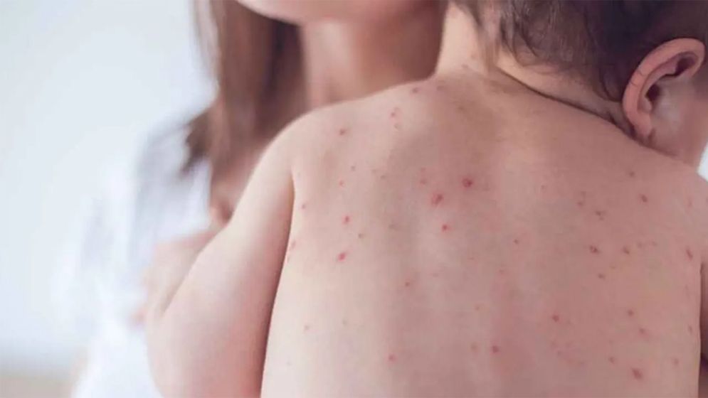 ময়মনসিংহে হামের উপসর্গে শিশুর মৃত্যু, ২৪ ঘণ্টায় ভর্তি ২৮