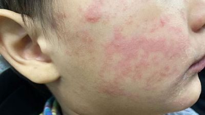 টিকাদানের ঘাটতিতে বাড়ছে হাম