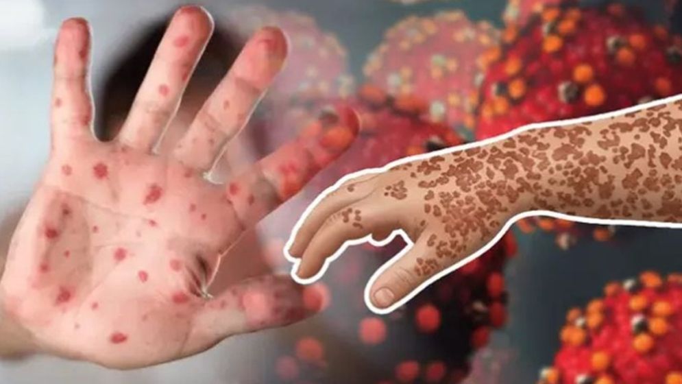 হাম ও উপসর্গে আরো ১২ জনের মৃত্যু